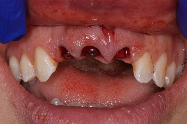 Close-up of patient with dental implants
