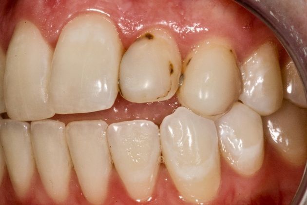 Patient's smile before veneer placement